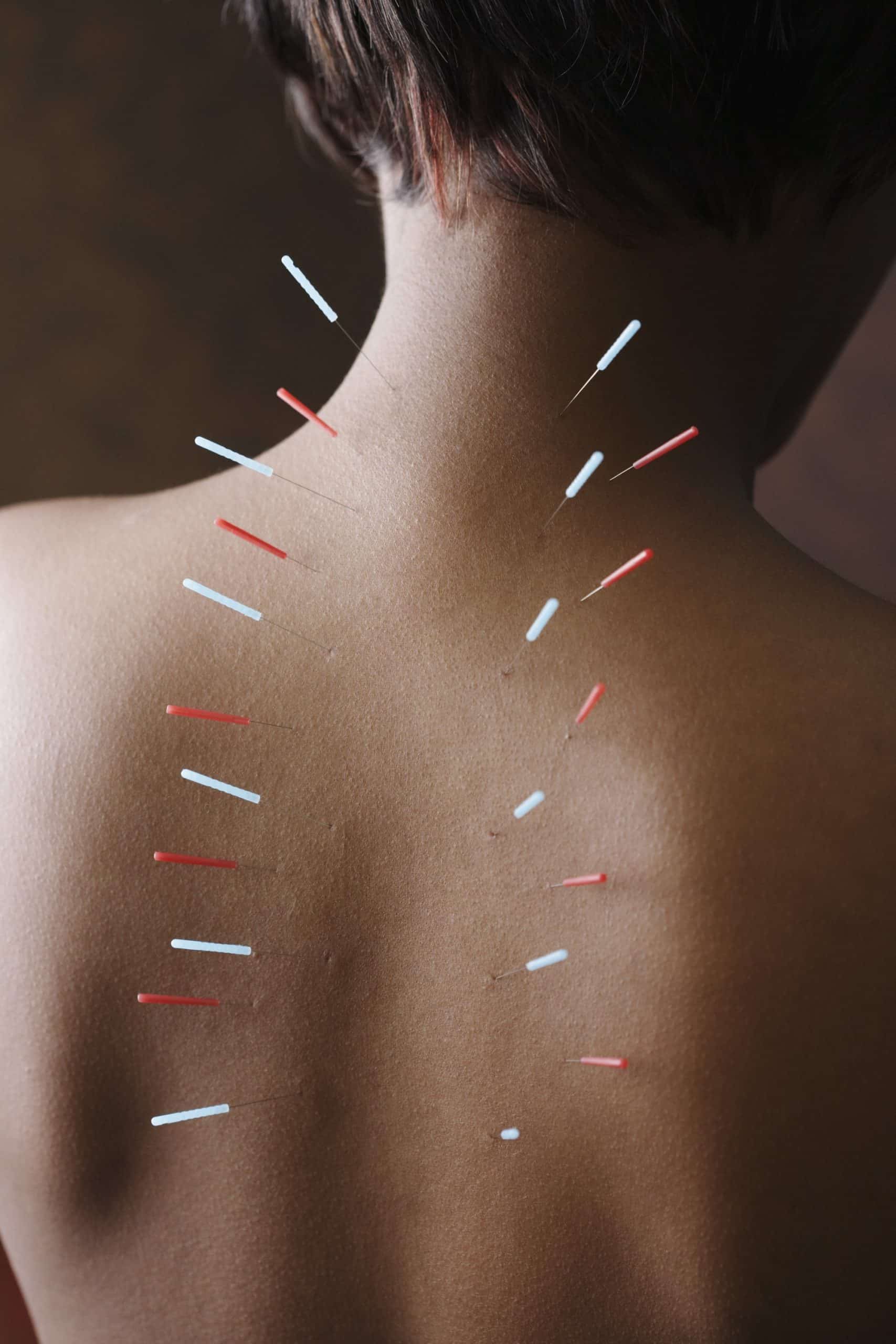 Acupunture.Tx_.Induced.Xerostomia_G_74596825
