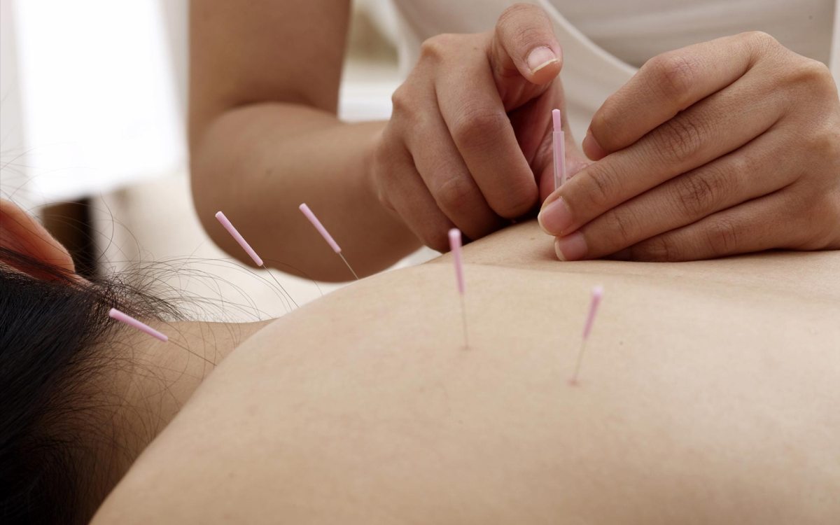 acupunctureinaction