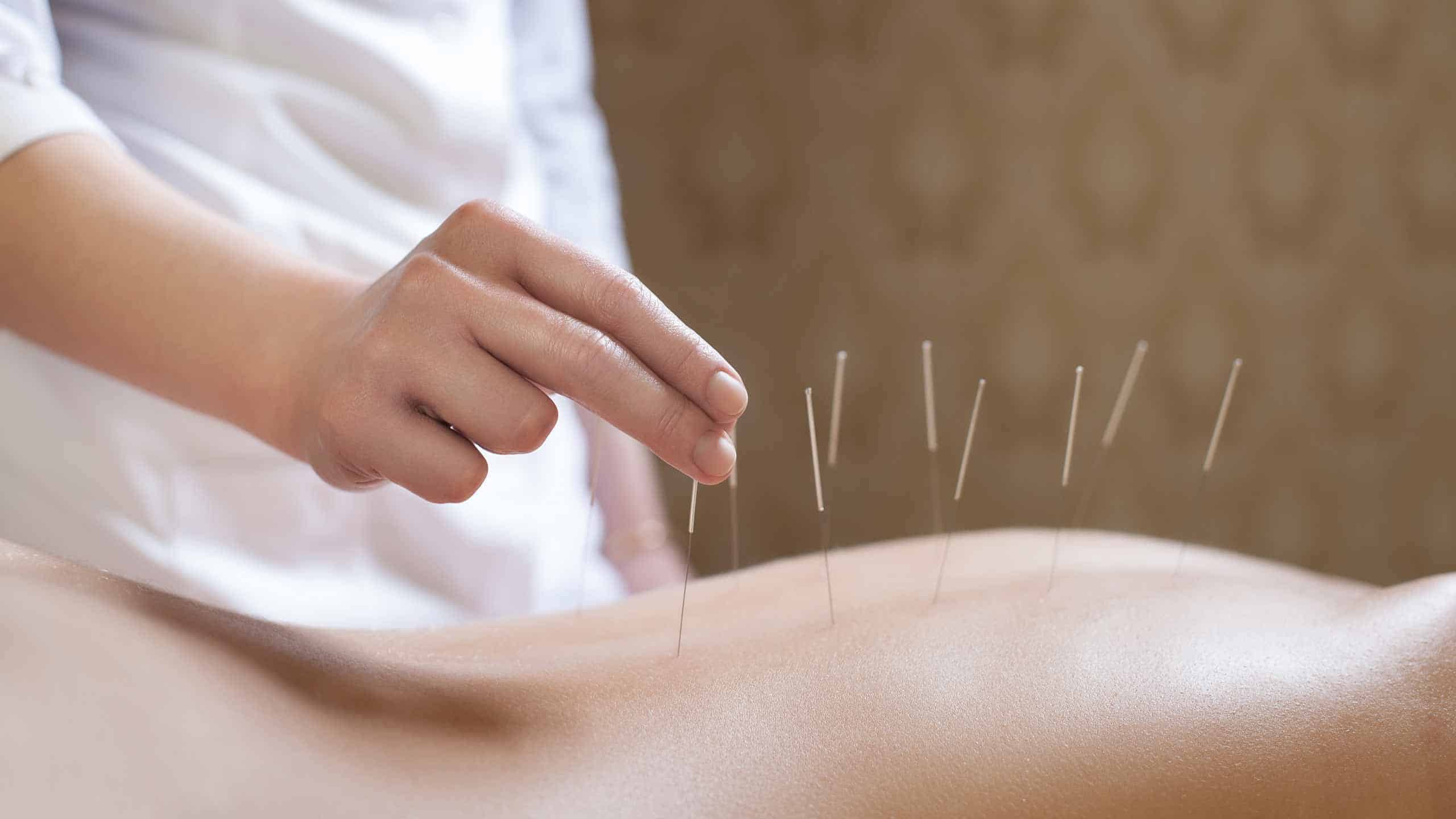 cropped-acupuncture